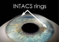 Intacs Rings After Implantation
