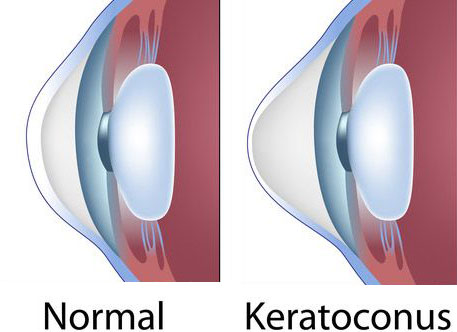 Normal Keratoconus