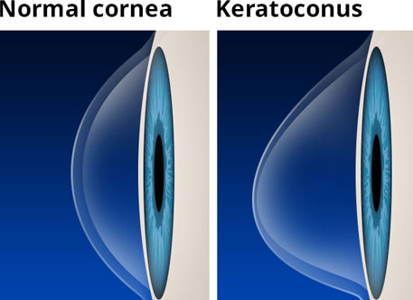 Normal Cornea and Keratoconus