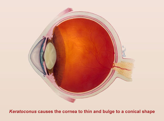 Keratoconus causes the cornea to thin and bulge to a conical shape