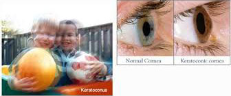Keratoconus Symptoms
